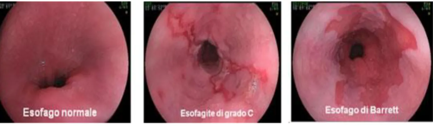 Figura 5. Gradi di esofagite 