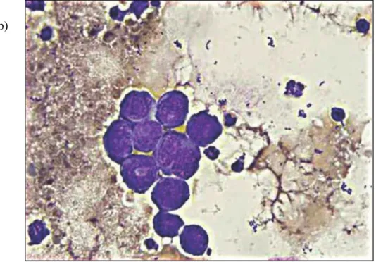 Figura 5.1 (a) Sedimento a fresco e (b) allestito con la colorazione di Wright  dalle urine di un cane affetto da carcinoma delle cellule di transizione e da  cistite  batterica