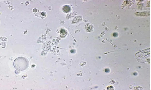 Figura  7.1  Ulteriori  comuni  reperti  del  sedimento  urinario  sono  le  gocce  lipidiche  e,  nei  soggetti  di  sesso  maschile, gli  spermatozoi