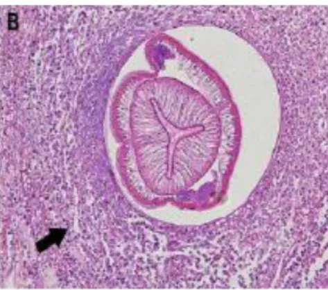 Fig 6: Biopsia ileale che mostra l’infiltrato eosinofilico attorno alla larva di  Anisakis (Dong Baek Kang et al., 2010) 