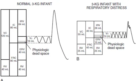 Figura 1.12: Il volume respiratorio nel neonato a termine A) sano; B) affetto da distress respiratorio [12].
