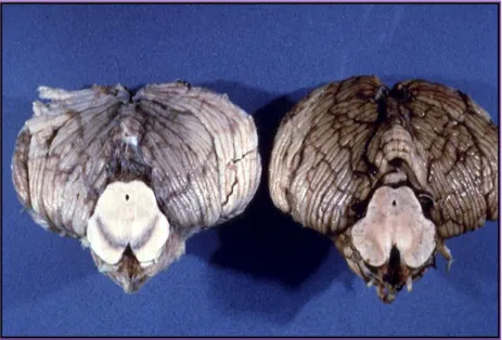 Figura 1.  Confronto  dell'aspetto della substantia  nigra  fra un cervello  normale e un cervello colpito  dal morbo di Parkinson
