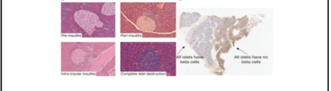 Figura	
  1	
  Infiltrato	
  linfocitario	
  in	
  topi	
  NOD	
  durante	
  la	
  progressione	
  del	
  diabete	
  