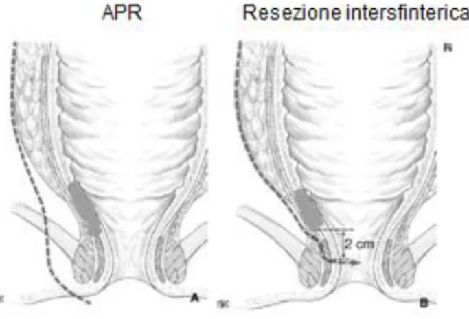 Figura 3: differenza tra l’amputazione addomino-perineale (a sinistra) e la resezione anteriore del retto con  salvataggio degli sfinteri (a destra).