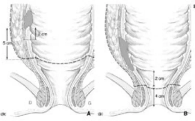 Figura 5: escissione mesorettale parziale (PME) a sinistra, escissione mesorettale completa (TME) a destra