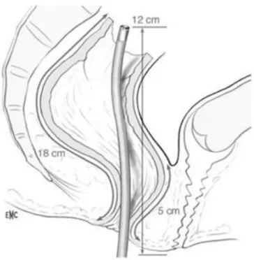 Figura 1: differenza tra strumento endoscopico flessibile (a sinistra) e rigido (a destra) nella misurazione della  distanza del tumore rettale dal margine anale.
