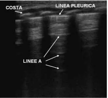 Illustrazione 8. 38  Aspetto di un polmone normale.(Esplorazione con sonda lineare) 