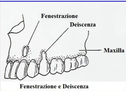 Figura 1.8 - Disegno schematico che illustra i difetti ossei orizzontali: la fenestrazione e la  deiscenza