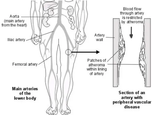 Figure 1-3:Scheme of peripheral artery diseases 