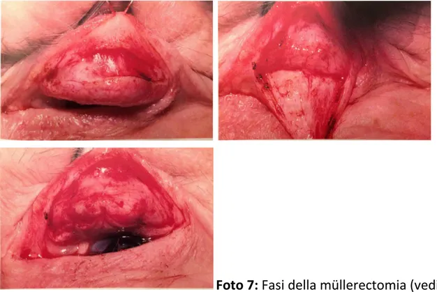 Foto 7: Fasi della müllerectomia (vedi testo)    (Colour atlas of ophthalmic plastic surgery; Tyers,Collin; Third Edition, Elsevier 2008) 