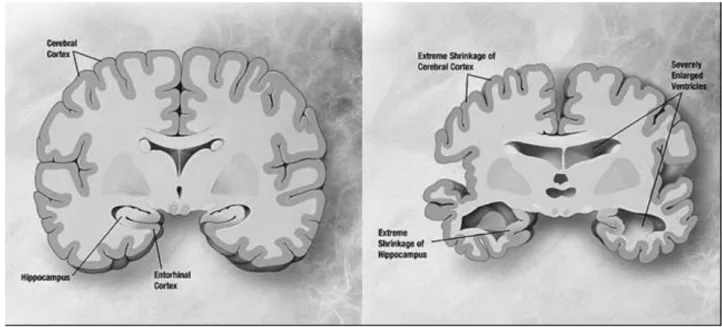 Figura 1. Caratteristiche dell’encefalo durante il normale invecchiamento (sinistra) e durante la Malattia di Alzhei- Alzhei-mer (destra)[da Mitra and Dey, 2013]