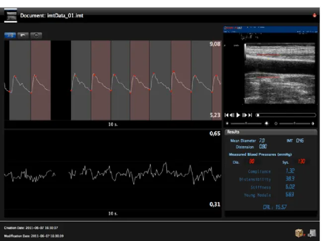 FIGURA 3: Interfaccia grafica del sistema automatico utilizzato per la valutazione istantanea  del diametro (in alto a sinistra ) e dello spessore medio-intimale carotideo (in basso a sinistra).