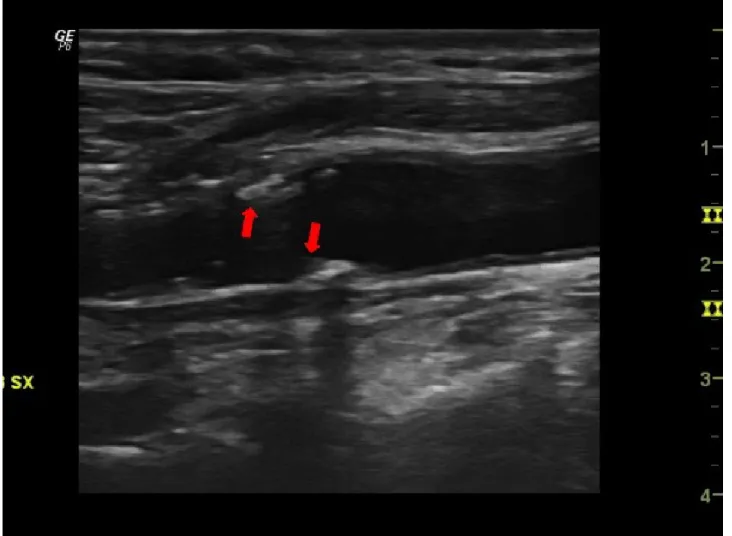 FIGURA   4:  Esempio   di   placca   a   livello   del   bulbo   carotideo:   le   frecce   in   rosso   indicano  presenza di placca sia sul bordo inferiore che su quello superiore