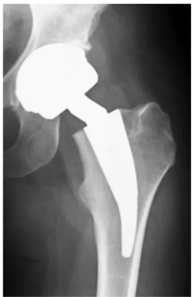 Fig.	
  12: 	
  Rx	
  controllo	
  dopo	
  impianto	
  di	
  Protesi	
   totale	
  di	
  anca	
  modello	
  BBraun	
  Metha®	
  