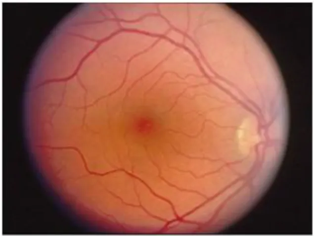 Fig. 8: Opthalmoscopic appearance  of the retina to show the macula 