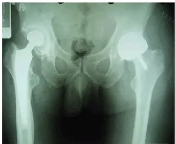 Illustrazione 11: Paziente con  un'artroprotesi a destra e una hip  resurfacing a sinistra
