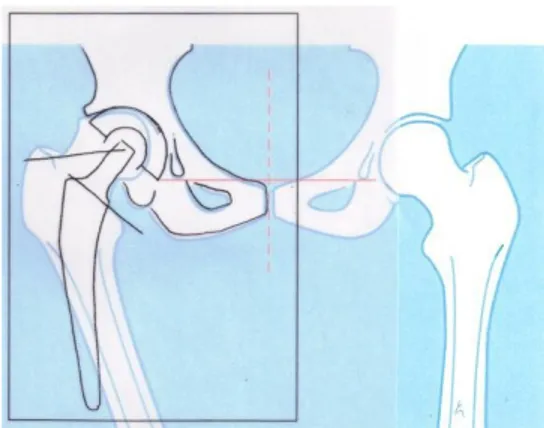 Illustrazione 20: Lucido della  protesi sovrapposto ad un esempio  di radiografia