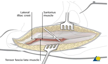 Illustrazione 24: Sezione dell'interstizio fra il tensore della  fascia lata e il sartorio