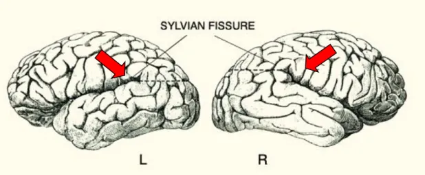 Fig.  3:  Asymmetries  of  the  SF.  The  SF  is  typically  longer  and  straighter  in  the  left  hemisphere  than  in  the  right  hemisphere