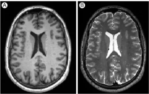 Figure  6:  Images  with  different  contrast:  the  same  slice  has  been  acquired  both  with  T 1   weighted  (A)  and  T 2