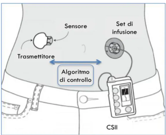 Figura 7. Componenti del Pancreas Artificiale 