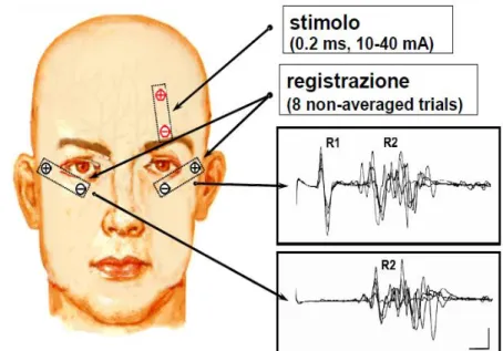 Fig. 1 Riflesso di blinking evocato elettricamente 