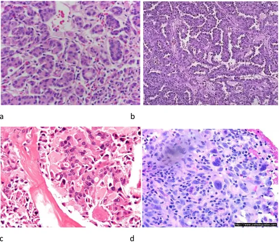 Figura 1.3: Sezioni istologiche dei carcinomi tiroidei: a) Follicolare, b) Papillare,   c) Midollare, d) Anaplastico 