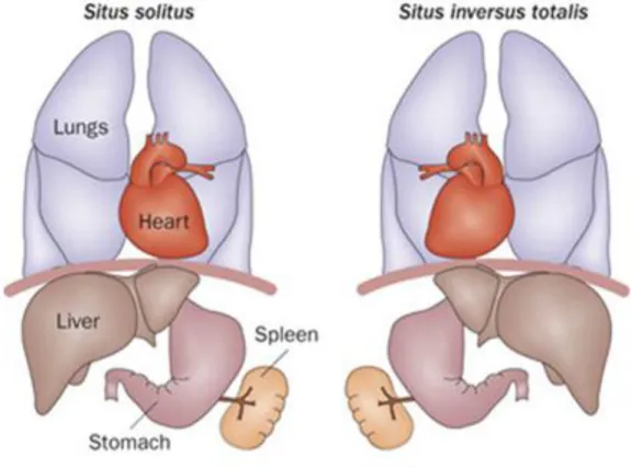 Figura  3.6:  Confronto  della  disposizione  degli  organi  interni  in  un  soggetto  normale  (a  sinistra)  e  in  soggetto  con  situs  inversus  (a  destra)  (Patel  e  Honorè,  2010)