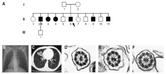 Figura 3.9: Albero genealogico della famiglia con DCP e immagini relative al situs  inversus, bronchiectasie, ultrastruttura ciliare normale (Schawabe et al., 2008)