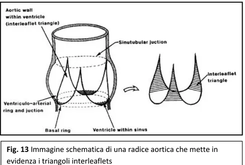 Fig. 13 Immagine schematica di una radice aortica che mette in  evidenza i triangoli interleaflets 