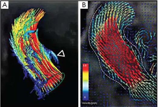 Fig. 16 Immagine acquisita con RMN flow-sensitive time-resolved 4D che  mostra i vortici nella radice aortica 