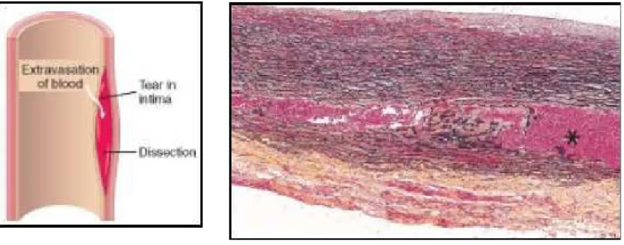 Fig. 17 A destra immagine schematica di dissezione; a sinistra preparato istologico che  mostra ematoma aortico intramurale (asterisco) 