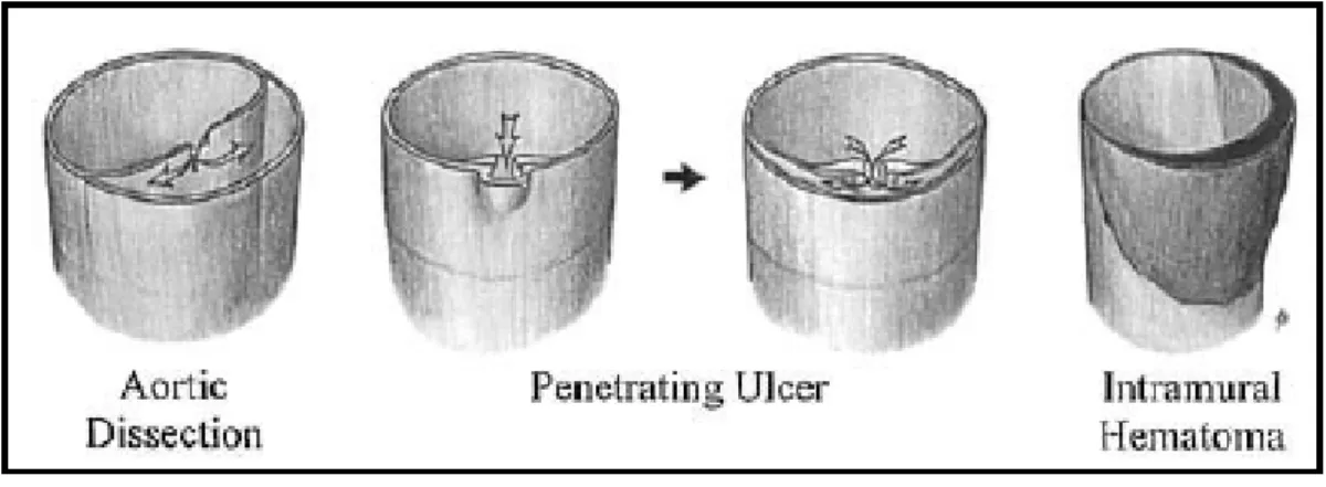 Fig. 19 Schema rappresentante le differenze fra dissezione, ulcera penetrante e  ematoma intramurale 