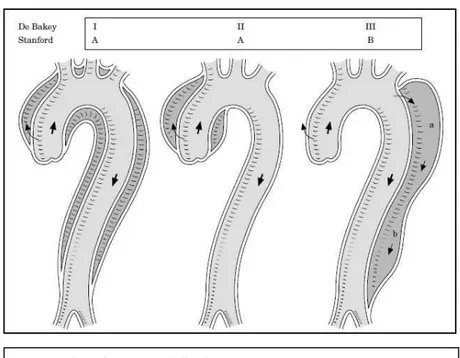 Fig. 20 Classificazione della dissezione aortica 
