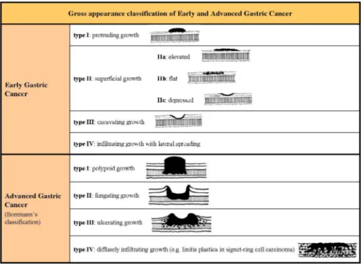 Fig 1. Gross appearance classification of Early and Advanced Gastric Cancer 4, 14