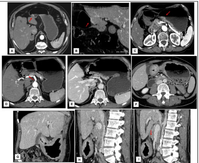 Fig  6.  Axial  and  MPR  images  of  misdiagnoses.  A-C:  Focal  thickness  of  the  inner  hyperattenuating  layer  of  the  gastric  wall  (arrows)  with  a  low-attenuating  stripe  of  the  submucosal  layer;  cT1  pT2  (A  and  B  are  images  of  th