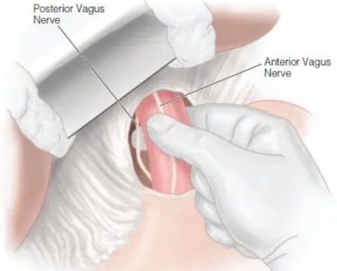 Figura 7- Vagotomia. Viene inciso il peritoneo e si esplora la regione intorno all’esofago