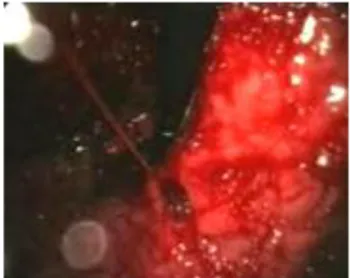 Fig. 13- Immagine endoscopica di ulcera gastrica sanguinante 