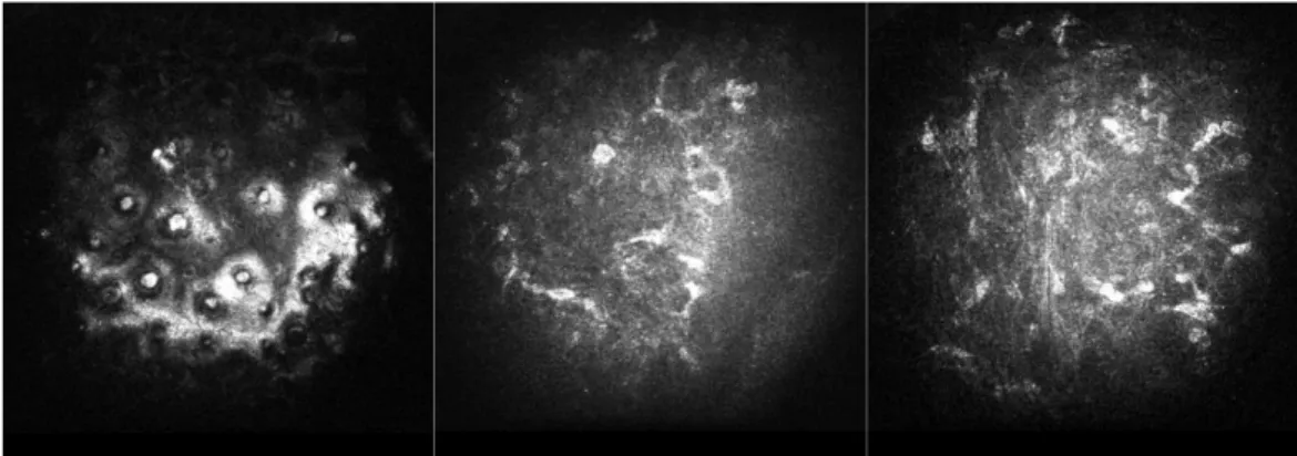 Fig 8. Analisi con microscopia confocale in vivo pre- DSAEK 