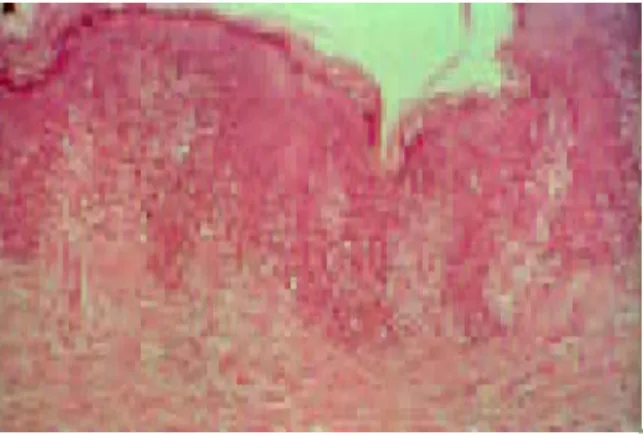 Fig. 2. A dense intraepidermal pagetoid in ltrate of medium/large clinicopathological  ndings and heterogeneous immuno-