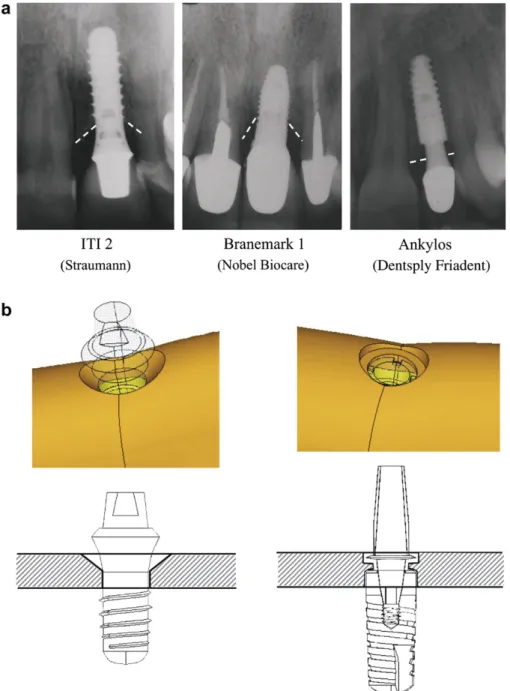 Fig. 3. Geometrical modelling of crestal bone loss induced by implant shape. Periapical radiographs showing crestal bone loss for Straumann, Nobel Biocare and Ankylos implants after a healing period of about 1 year (a); modelling of a signiﬁcant ‘‘ﬂaring” 