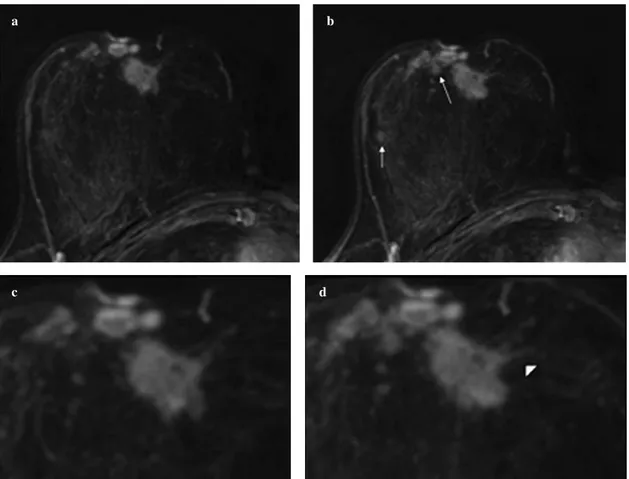 Fig. 1a-d Multicentric ductal invasive cancer in 55-year-old woman. a Dynamic subtraction magnetic resonance (MR) image of first postcontrast acquisi- acquisi-tion of convenacquisi-tional 2D gradient echo, (matrix , 256 ×256, temporal resolution ≤ 80 s)