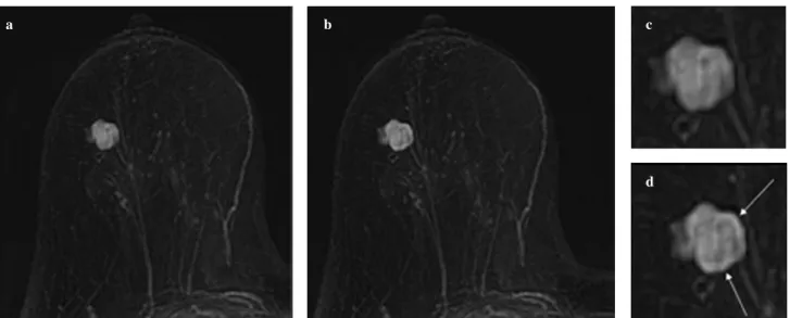 Fig. 2a-d Fibroadenoma in 47-year-old woman. a Dynamic subtraction magnetic resonance (MR) image of first postcontrast acquisition of conventional 2D gradient echo (matrix, 256 ×256, temporal resolution ≤ 80 s)