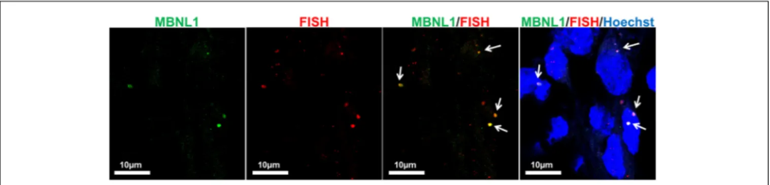 FIGURE 11 | Co-localization of CCUG-containing ribonuclear foci with MBNL1 protein. Representative confocal microscopic images showing the presence of RNA-FISH of foci (red) co-stained with the splicing factor MBNL1 (green) in DM2- derived neuron (D2)