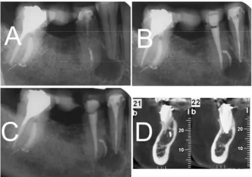 Figure 1. (A) Periapical x-ray showing a large radiolucent periradicular lesion extending  from the apical to the mesial aspect of the root of tooth 4.5 and the apex of tooth 4.4; (B)  Periapical X-ray showing a large lateral canal on tooth 4.5 after the e