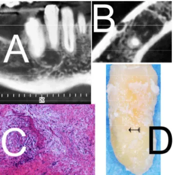 Figure 2. (A) Eighteen months CBCT analysis after retreat-  ment/treatment revealed periradicular radiolucency suggestive  of persistent disease; (B) Eighteen months CBCT analysis show-  ing lesion close to the mental foramen; (C) Histopathology image  sho