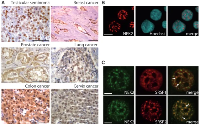 Figure 1. NEK2 localizes in the nucleus of cancer cells. (A) Immunohistochemistry of NEK2 in testicular seminomas, breast, prostate, lung and cervix cancer specimens (scale bar = 25 mm)