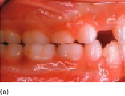 Fig. 10 Case 2: occlusal ramps used for to treat posterior crossbite on right side.
