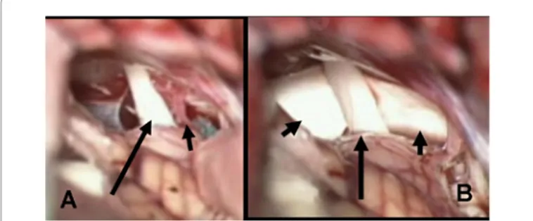 Figure 3: Operative view, at the operative microscope, of the vascular conflict  between trigeminal nerve and anterior inferior cerebellar artery (A) and view of  the trigeminal nerve separated from the artery (anymore visible) by a patch of  synthetic dur