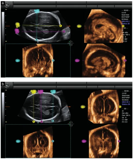 Figure 1 Example, using a normal fetal brain, of application of our new algorithm to reconstruct sagittal and coronal planes of the fetal brain from volume datasets acquired by three-dimensional ultrasound